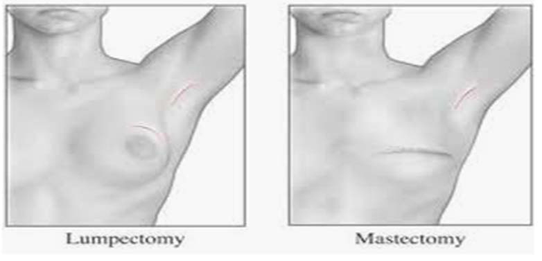 lumpectomy-mastectomy