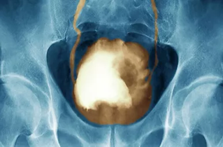 bladder-cancer