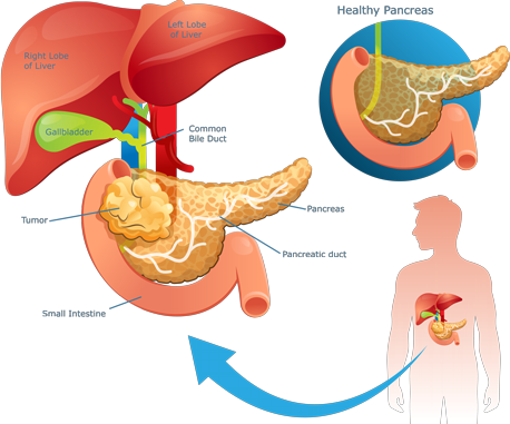 pancreatic-cancer